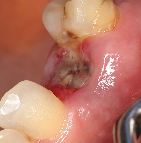 Let's talk about alveolitis - an unpleasant complication that often occurs after tooth extraction and is manifested by inflammation and suppuration of the hole, which reduces the rate of its healing.