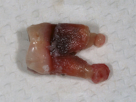 A tato fotka ukazuje skutečný extrahovaný zub s cystami na kořenech.