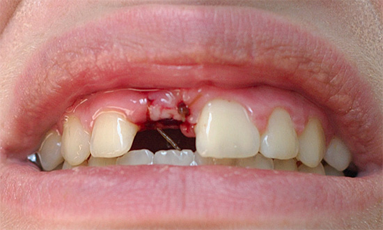 Pat ja zobu caurums pēc pašapstrādes vairs nav izbalējis, jums tomēr jākonsultējas ar zobārstu.