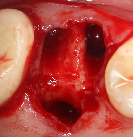 Da biste spriječili alveolitis, trebali biste pravilno paziti na rupu odmah nakon vađenja zuba, ne zanemarujući savjet liječnika.