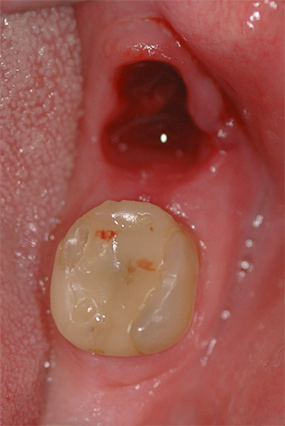 Alveolitis kann zu Hause behandelt werden, in den meisten Fällen ist jedoch weiterhin ein Zahnarztbesuch erforderlich.