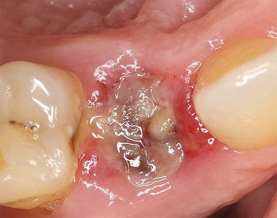 Fotografie ukazuje vzhled otvoru 2 dny po extrakci zubu.