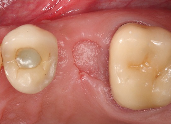 Plně zahojené dásně - vzhled dva měsíce po extrakci zubu.