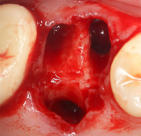 Haideți să vorbim despre câteva puncte importante privind oprirea sângelui după o procedură de extracție a dinților ...