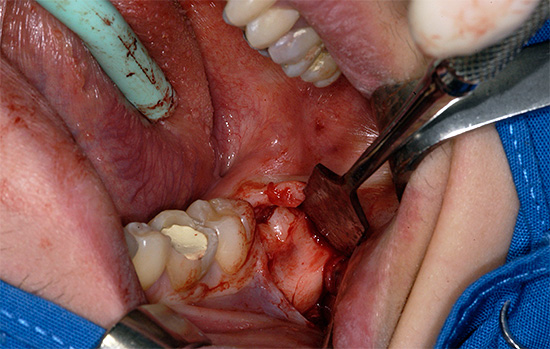 La photo montre l'ablation d'une dent de sagesse avec dissection préliminaire des gencives.