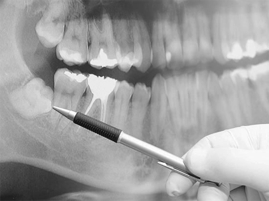 Le retrait des dents de sagesse en raison de leur emplacement non standard dans la mâchoire est considéré comme une opération de complexité accrue.