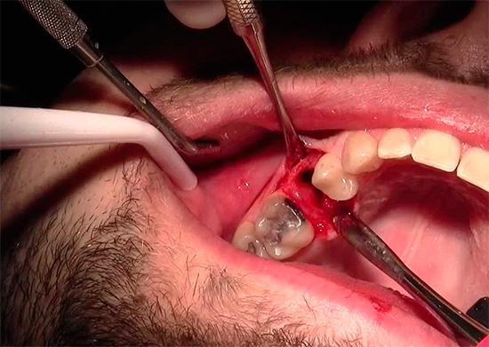 Blutungen können sich verstärken, wenn der Arzt gezwungen ist, die Wunde zu weit zu öffnen, um einen besseren Zugang zu den Zahnwurzeln zu erhalten.