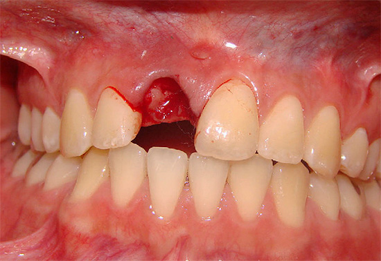 Hvis blodet fra hullet fremdeles ikke kan stoppes på egen hånd, bør du absolutt søke hjelp fra en tannlege.