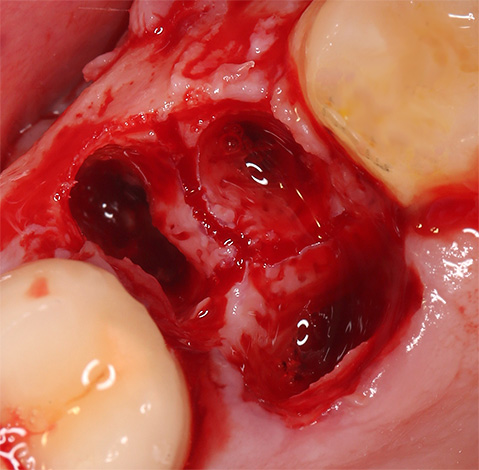La photo montre un trou de saignement frais à la place de la dent extraite.