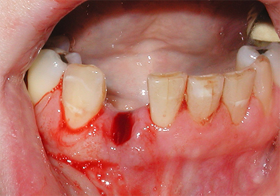 Krvarenje nakon vađenja zuba obično bi trebalo prestati nakon 10-30 minuta.