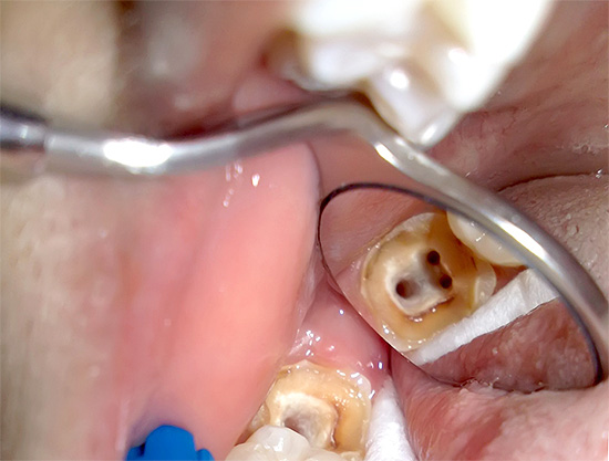 La oss snakke om funksjonene i behandlingen av pulpitt av tre-kanals tenner og prisene for denne prosedyren i moderne tannlegeinstitusjoner ...