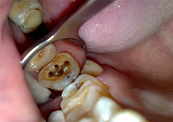 Four-channel tooth
