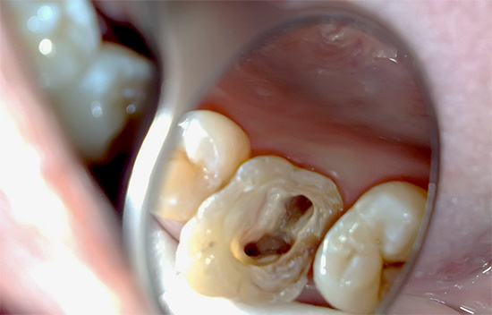 Prisen for behandling av pulpitt av en tre-kanals tann er vanligvis ganske høy, på grunn av den økte kompleksiteten i arbeidet, samt økt tid og materialer.