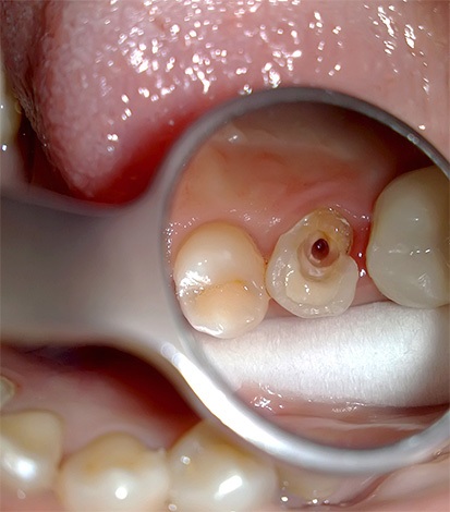 La photo montre le traitement de la pulpite d'une dent à canal unique.