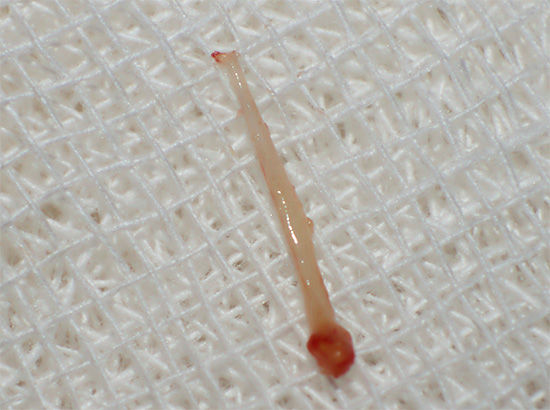 Une autre photographie de la pulpe dentaire - dans le traitement de la pulpite d'une dent à trois canaux, un nerf doit être retiré de chaque canal.