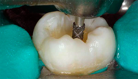 Zahnpräparation mit einem Bohrer.