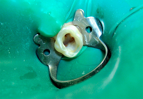 Cofferdam - ชิ้นส่วนของน้ำยางที่มีฟันที่แยกได้จากช่องปากในระหว่างการยักย้ายถ่ายเท