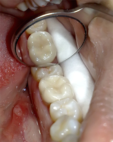 E questo è come appare un dente a tre canali dopo il trattamento della pulpite e l'installazione di un riempimento permanente.