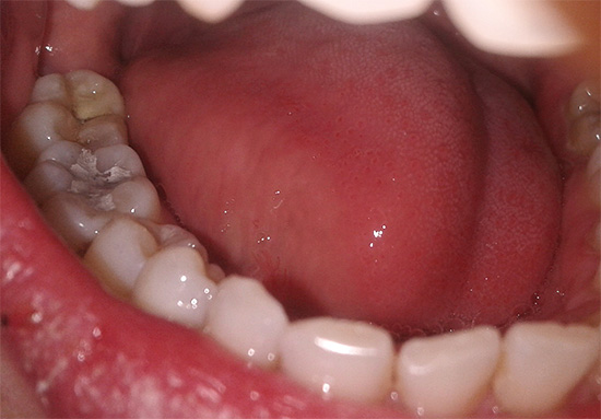 Das Foto zeigt eine vorübergehende Füllung des Zahns (das sogenannte Arsen).
