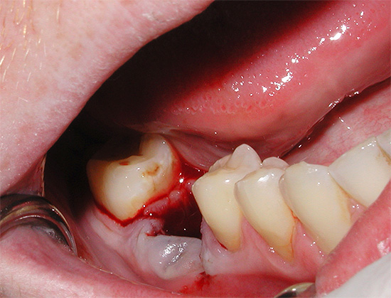 Selepas gigi dikeluarkan, pipi membengkak sangat kerap, tetapi sukar bagi seseorang yang biasa memahami sendiri sama ada ini adalah normal atau sebaliknya, berbahaya kepada kesihatan.