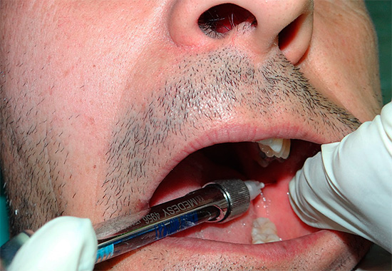 Skruostų ir dantenų patinimas gali atsirasti jau vartojant anestetiką.