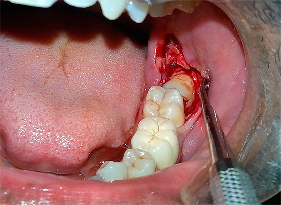 À la suite d'une lésion des tissus mous et durs, un processus inflammatoire et un œdème se développent près de la dent enlevée.
