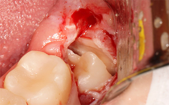 Fotografie ukazuje příklad komplexního odstranění zubu moudrosti, když je odebrán doslova po částech z díry.