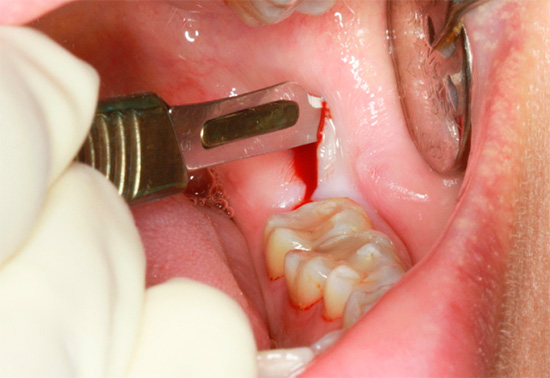 Když odstraníte retardovaný zub moudrosti, nejprve se rozřízne guma, pod níž je umístěn.