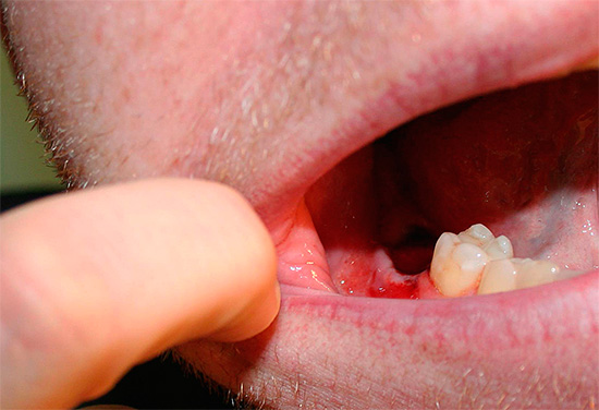 Si consultó a un médico después de extraer un diente para recibir ayuda repetida, lo más probable es que, además de un examen externo, también se requiera una radiografía del orificio.