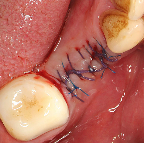 Dikişler diş soketinin kenarlarına yerleştirilebilir.