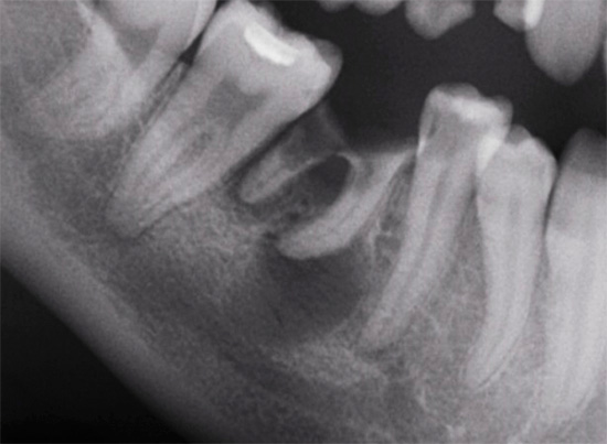 Zo ziet parodontitis eruit op een röntgenfoto (röntgenfoto)