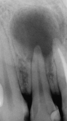 Een donkere vlek in de afbeelding is een teken van parodontitis.