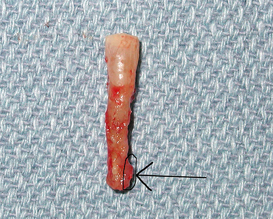 The photo shows a tooth with a cyst on the root.