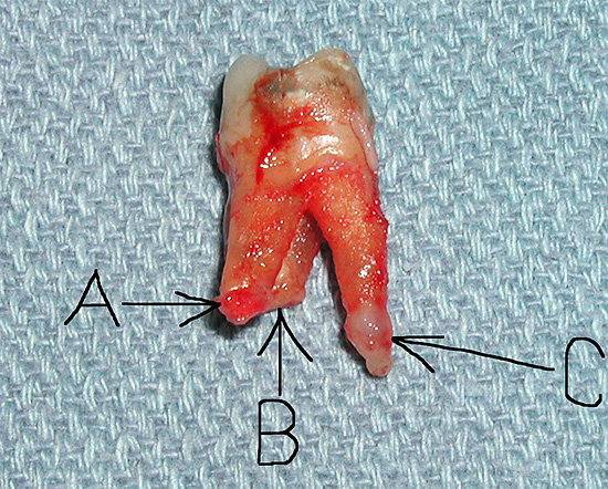 A tu je ďalší zub s cystami na koreňoch.