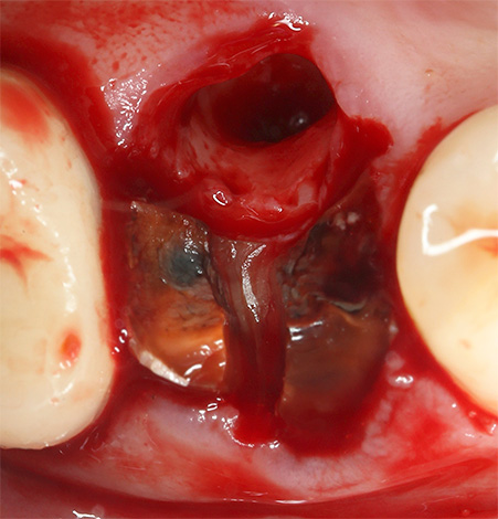 Pokud lékař omylem nevytahuje z otvoru alespoň část kořene zubu, může se kolem něj vytvořit cysta.
