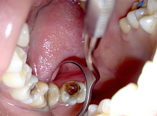 Considérez les principales étapes qui composent la procédure pour retirer un nerf d'une dent.