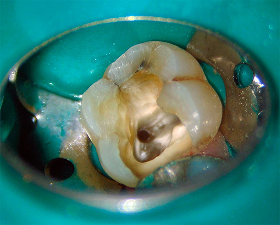 I dyra kliniker används cofferdam för att isolera en sjuk tand från munhålan.