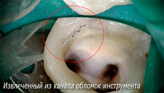 Fotografie ukazuje část fragmentu dentálního nástroje extrahovaného z kanálu.