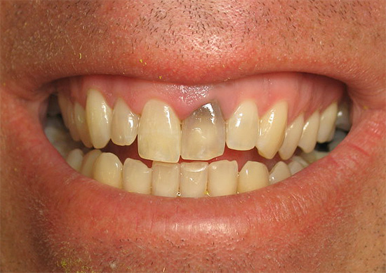 A volte dopo il trattamento della pulpite, il dente può scurirsi molto.