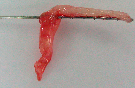 Fotografi av en nerve fjernet fra en tann (masse)
