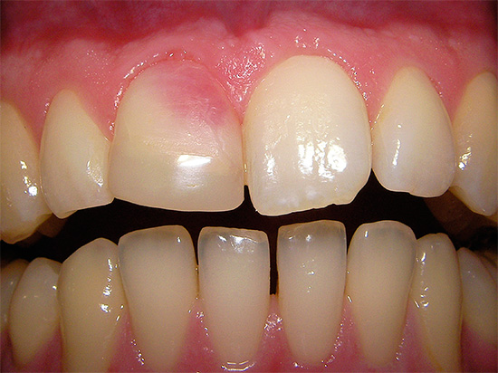 Og her er et eksempel på en rosa tann, hvis farge dukket opp på grunn av bruk av resorcinol-formalinpasta i behandlingen av kanalen.
