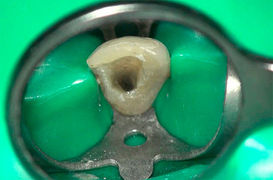 Por via de regra, o preço mínimo é obtido apenas no tratamento da pulpite de um dente de canal único.