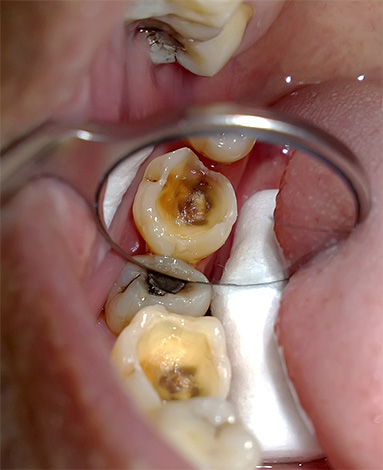 La foto mostra un dente cariato preparato per il trattamento endodontico.