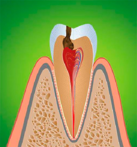 La inflamación del nervio dental conduce a la pulpitis, que generalmente se acompaña de dolor agudo.