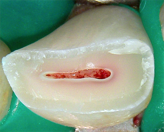 Das Foto zeigt einen gebrochenen Zahn - Sie müssen auch den Nerv entfernen.