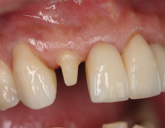 Quando si prepara un dente per una corona, è spesso pre-pulpato, ma è sempre necessario? ..