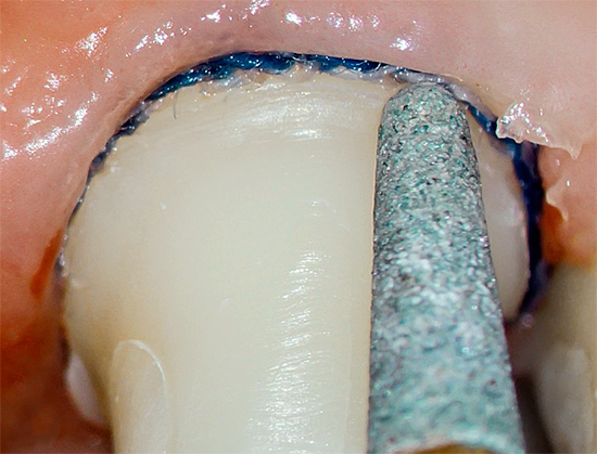 Počas brúsenia zuba pod korunou sa nerv vnútri môže prehriať, čo následne vedie k pulpitíde.