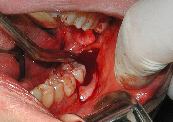 Il vantaggio dell'anestesia è la possibilità di manipolazioni indolore lunghe e traumatiche, ad esempio associate alla rimozione complessa di un dente del giudizio.