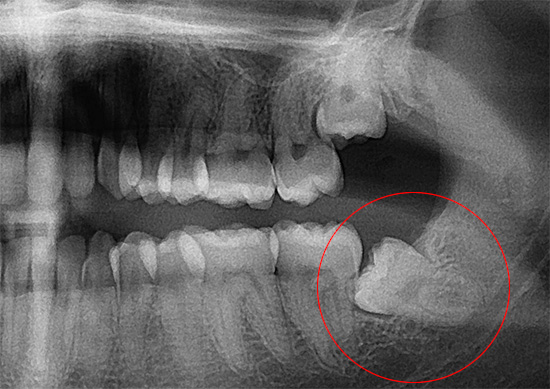Sur cette radiographie, une dent de sagesse mal positionnée dans la mâchoire est clairement visible.