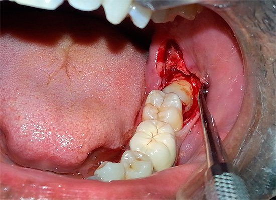 Als blijkt dat anesthesie voor u gecontra-indiceerd is, dan zult u de tand op de ouderwetse manier moeten verwijderen - met lokale anesthesie.